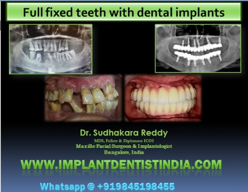 sinus bypass