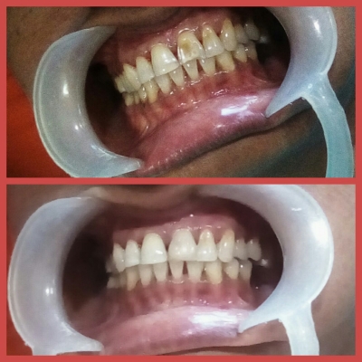 Composite filling