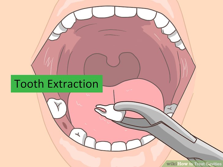 Cavity