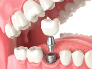 Cavity