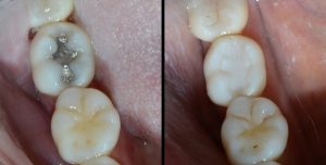 Cavity