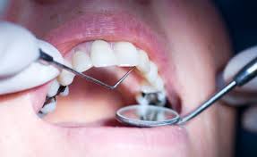 Tooth Fillings