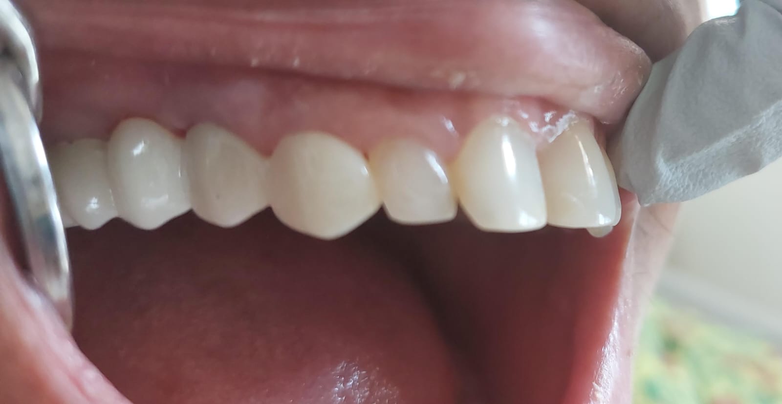 Braces -(Before)