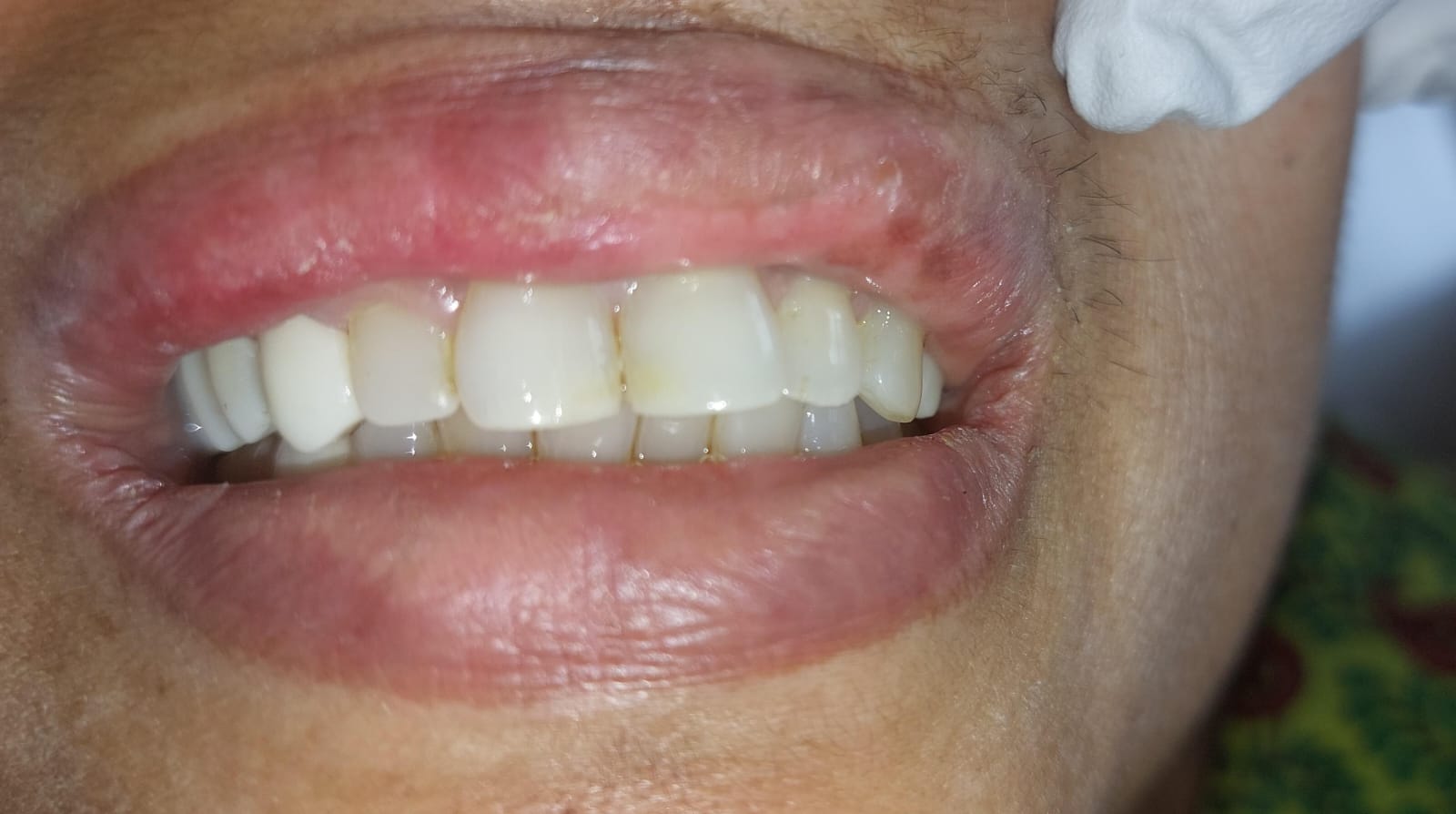 Access Cavity Restoration