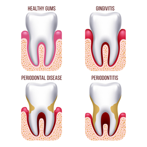 RCT -(Before)