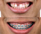 Braces