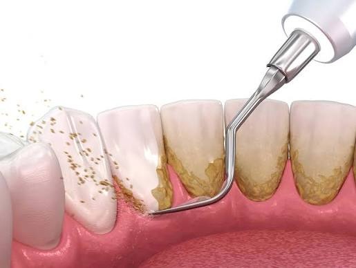 Teeth scaling 