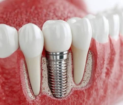 Implants