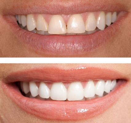 TEETH