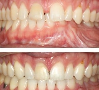 DIASTEMA