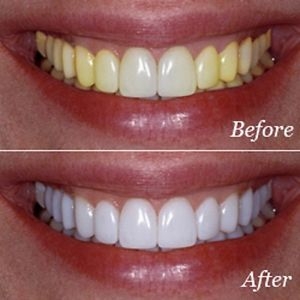 VENEERS