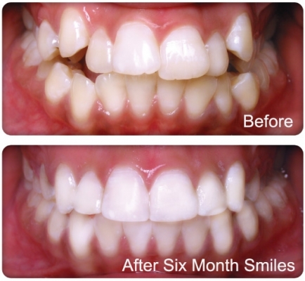 BRACES