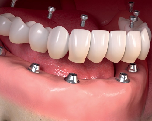 full mouth rehabilitation