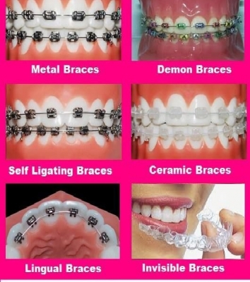 teeth bleaching