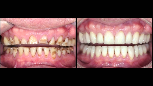 full mouth rehabilitation