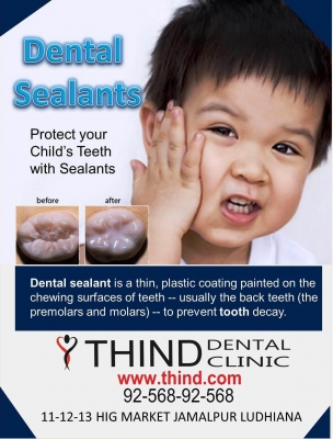 Dental Sealants