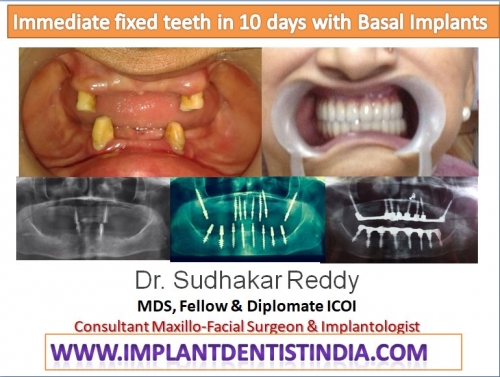 sinus bypass