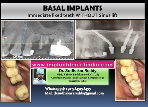 sinus bypass