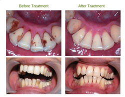 TEETH