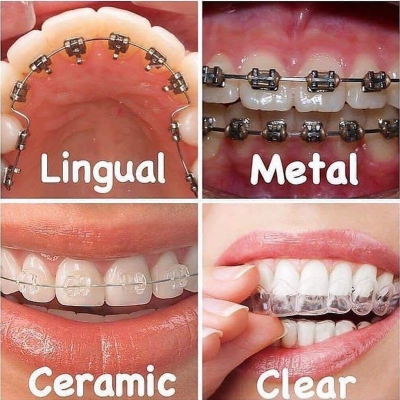 Lingual Braces