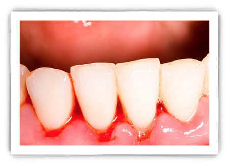 GUM