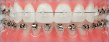 Ziconia Crowns