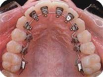 Dental Jewels