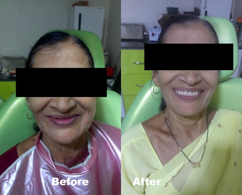 Complete Denture