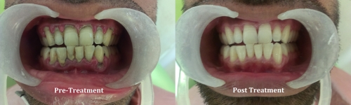 Complete Denture