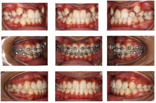 BRACES