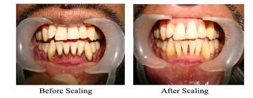 ORTHO TREATMENT