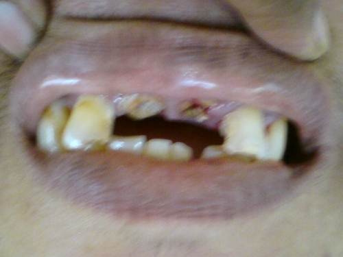 Cavity