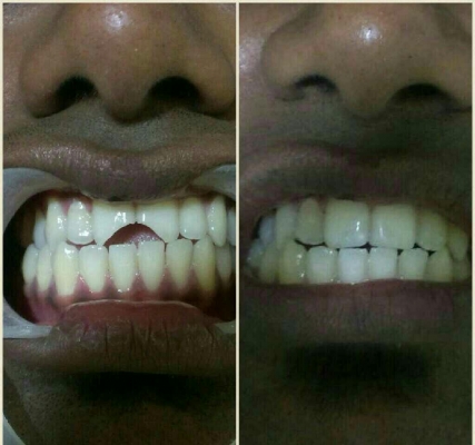 Complete Denture