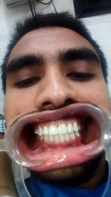 Composite filling