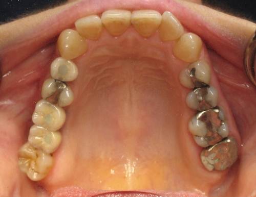 Implant Supported Bridge To Replace Multiple Missing Teeth -(After)