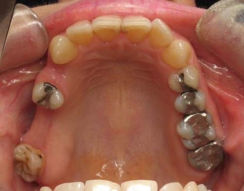 Implant Supported Bridge To Replace Multiple Missing Teeth -(Before)