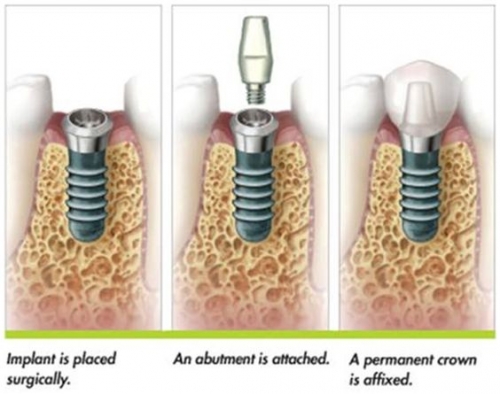 teeth bleaching
