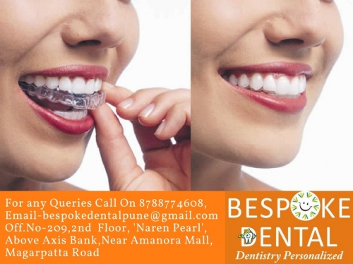 Lingual Braces