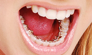 Lingual Braces