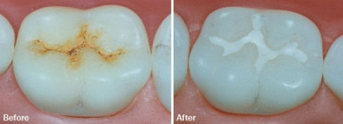 CAVITY
