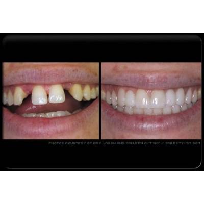 Cavity