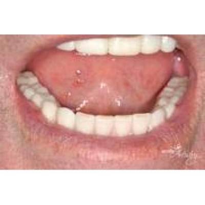 Cavity