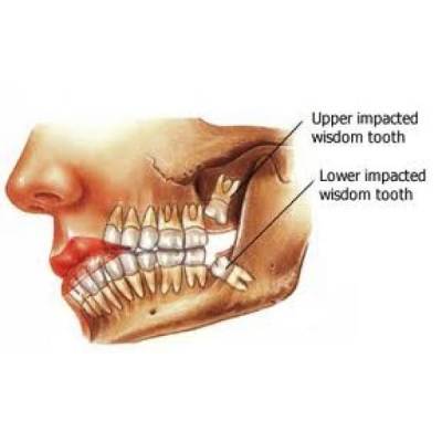 Cavity