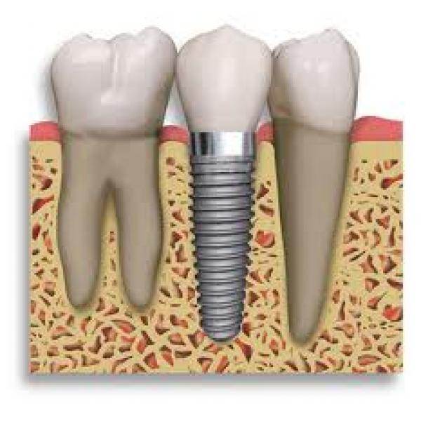 Cavity