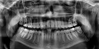 Root Canal Treatment