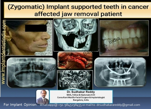 sinus bypass